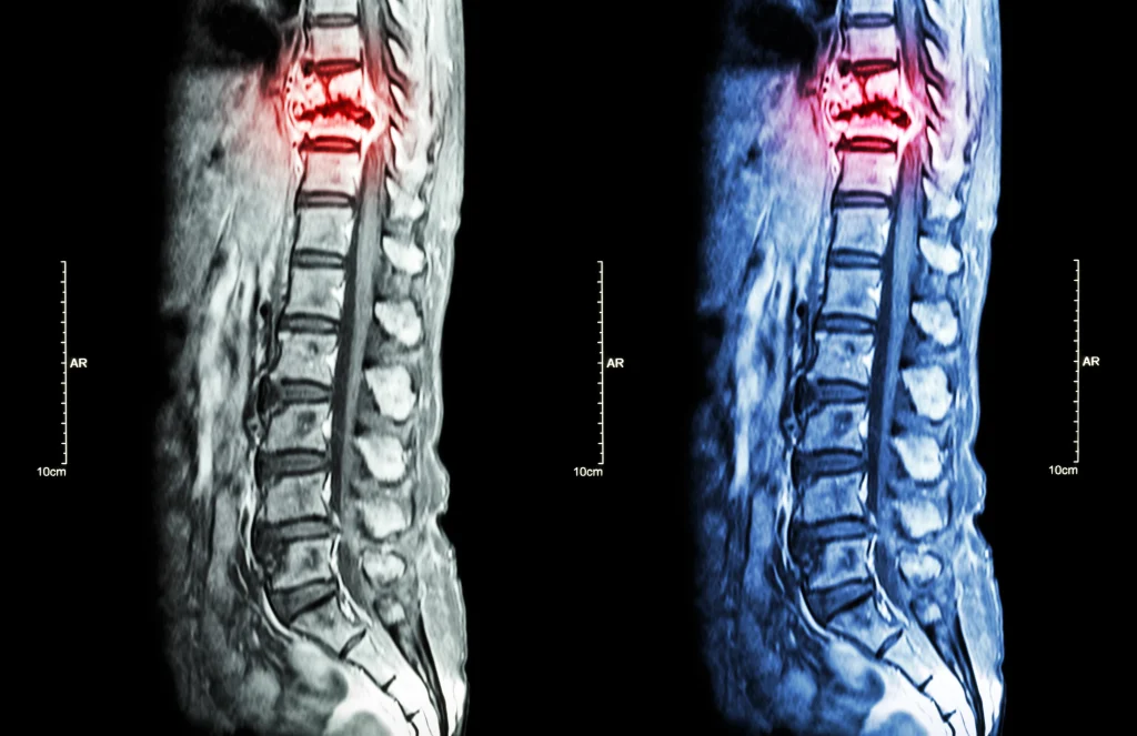 An x-ray of an injury to the spine.